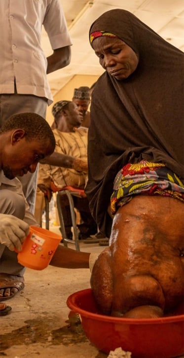 Woman with leg severely swollen due to lymphoedema, observing the washing of her leg