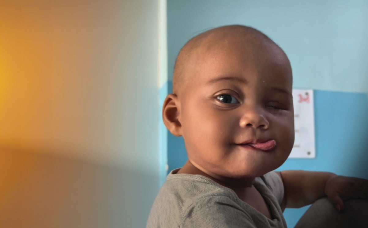 Baby Sombiniaina from Madagascar, following the removal of her right eye.