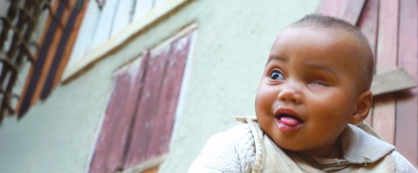 Baby Sombiniaina from Madagascar, following the removal of her right eye. Your love can light the way to save sight and even lives.