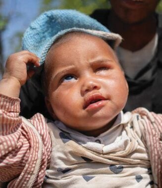 Baby Sombiniaina from Madagascar, following the removal of her right eye, wearing a blue hat. Your love can light the way to save sight and even lives.